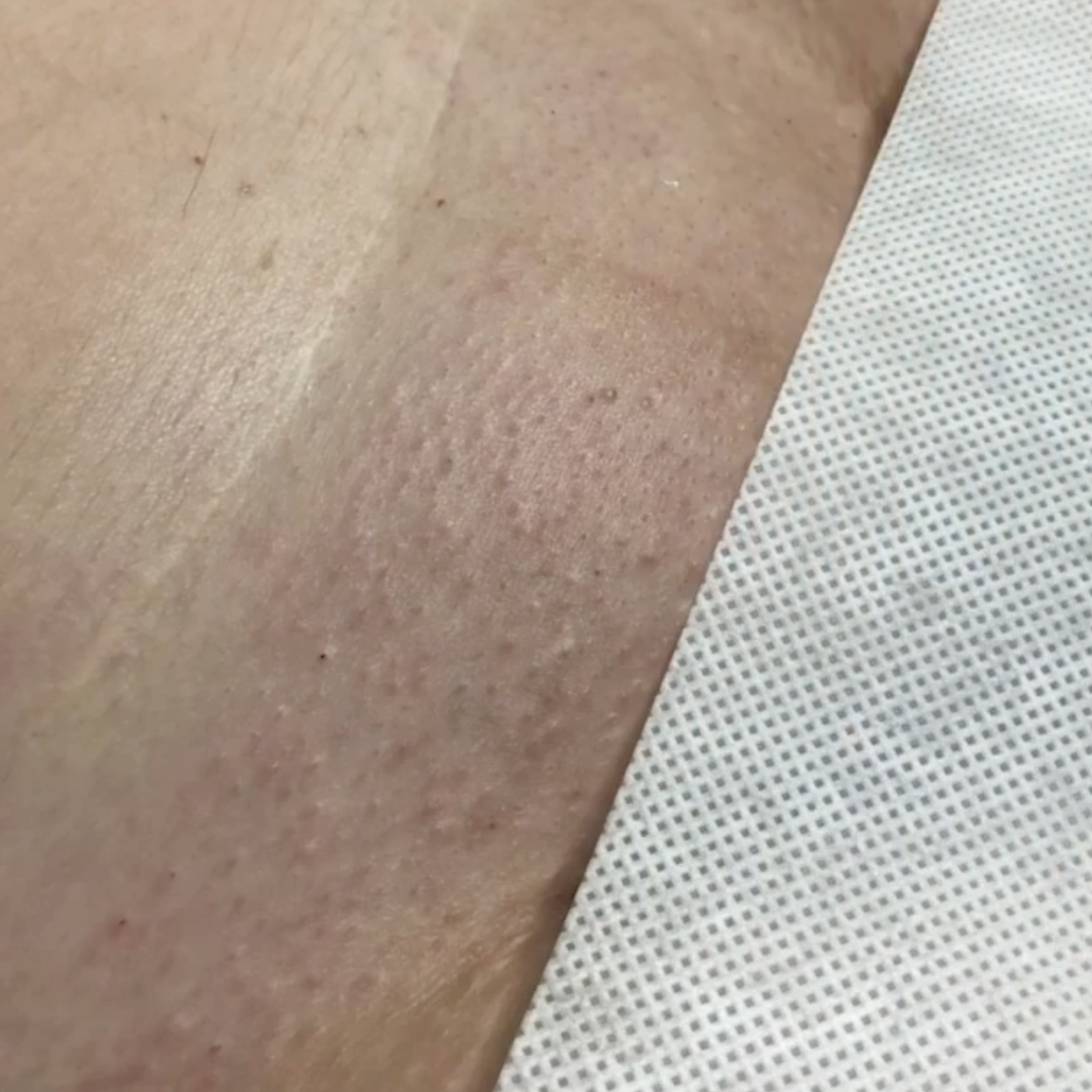 brazilian result - after